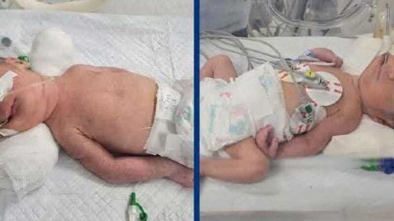 Medical Case in Sohag: Twins Delivered After Mother’s Passing